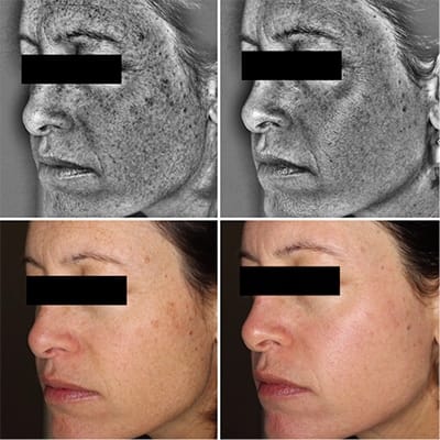 After one Halo treatment treated by Dr Christina Sander, dermatologist